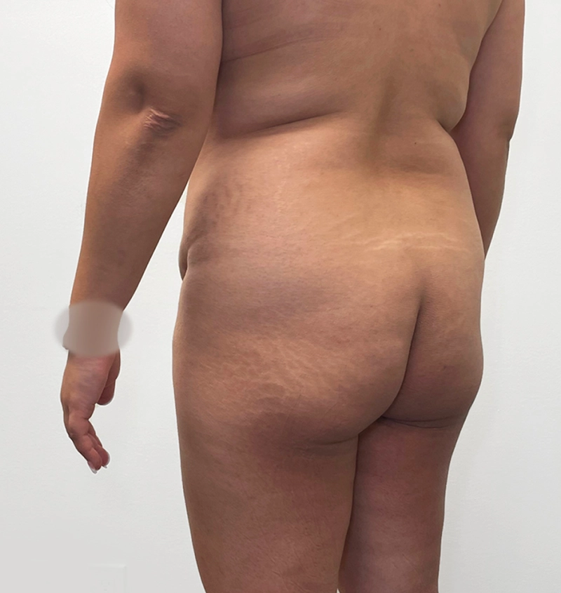 BBL before and after from mommy makeover