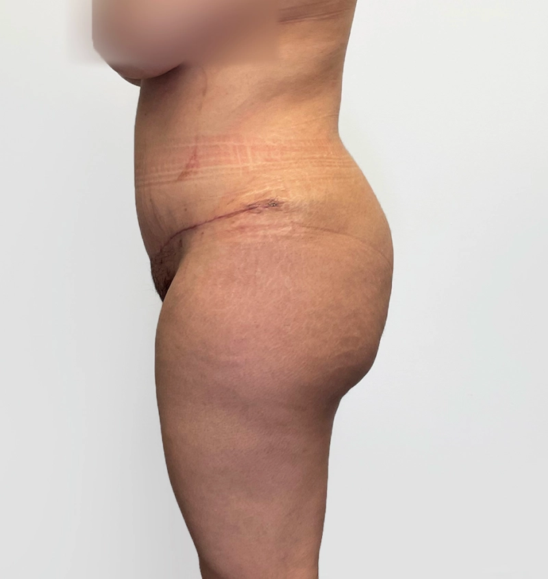 BBL before and after from mommy makeover