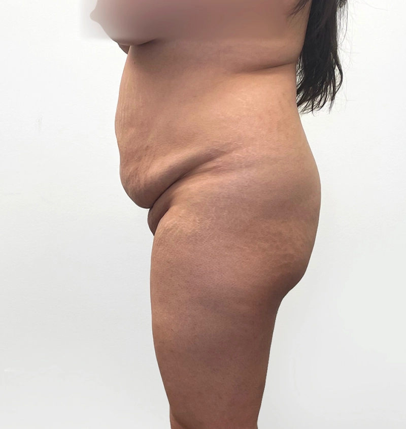 BBL before and after from mommy makeover