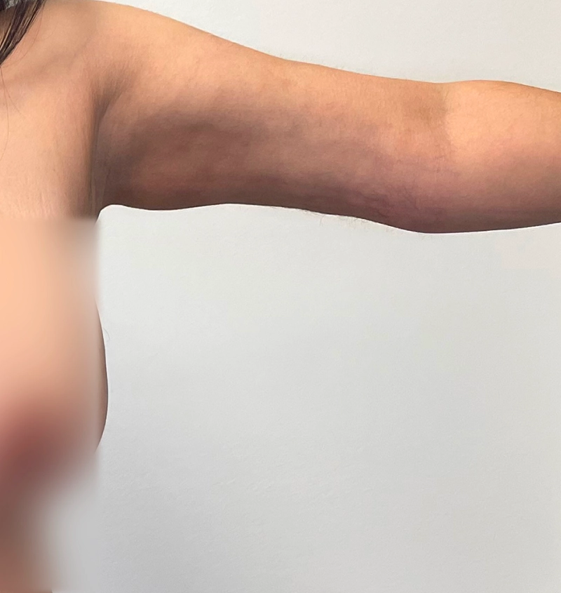 Arm liposuction before and after from mommy makeover