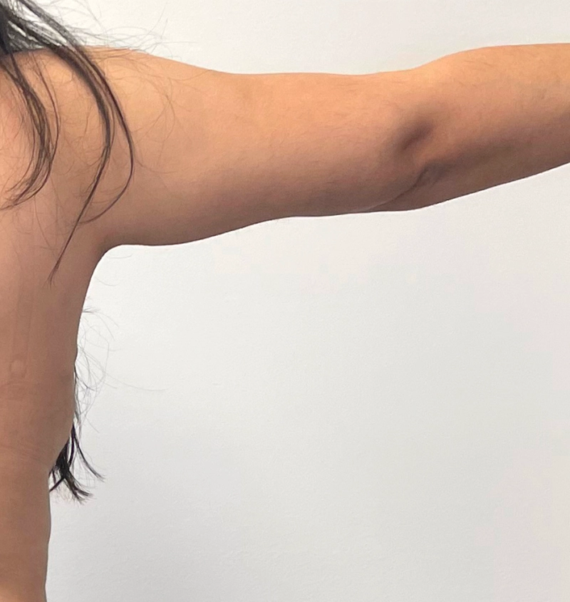 Arm liposuction before and after from mommy makeover