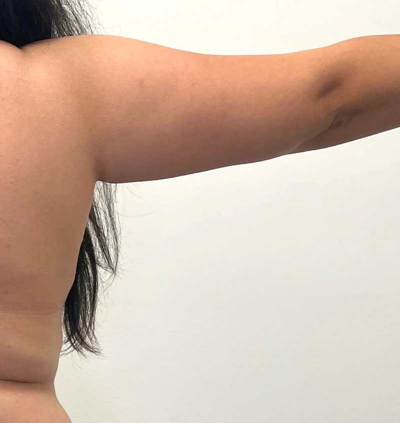 Arm liposuction before and after from mommy makeover