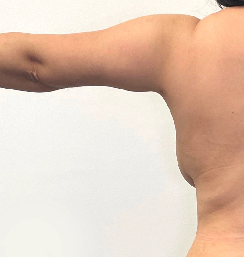 Arm liposuction before and after from mommy makeover