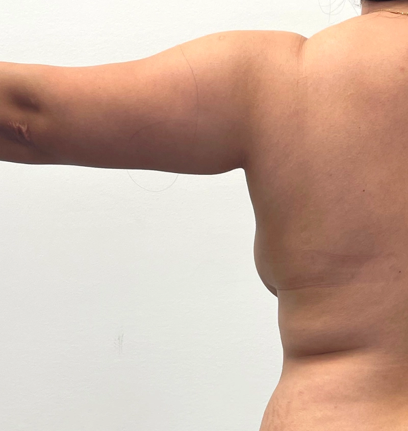 Arm liposuction before and after from mommy makeover