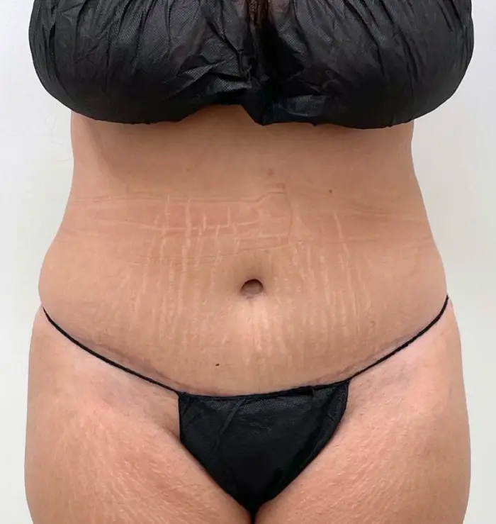 Tummy tuck before and after from mommy makeover
