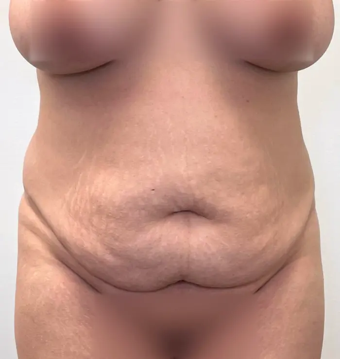 Tummy tuck before and after from mommy makeover