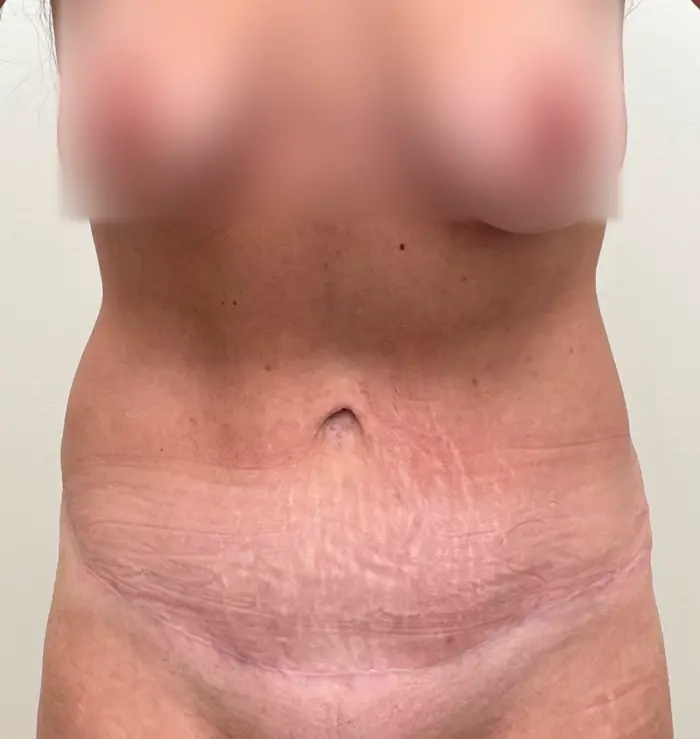 Tummy tuck liposuction results front view