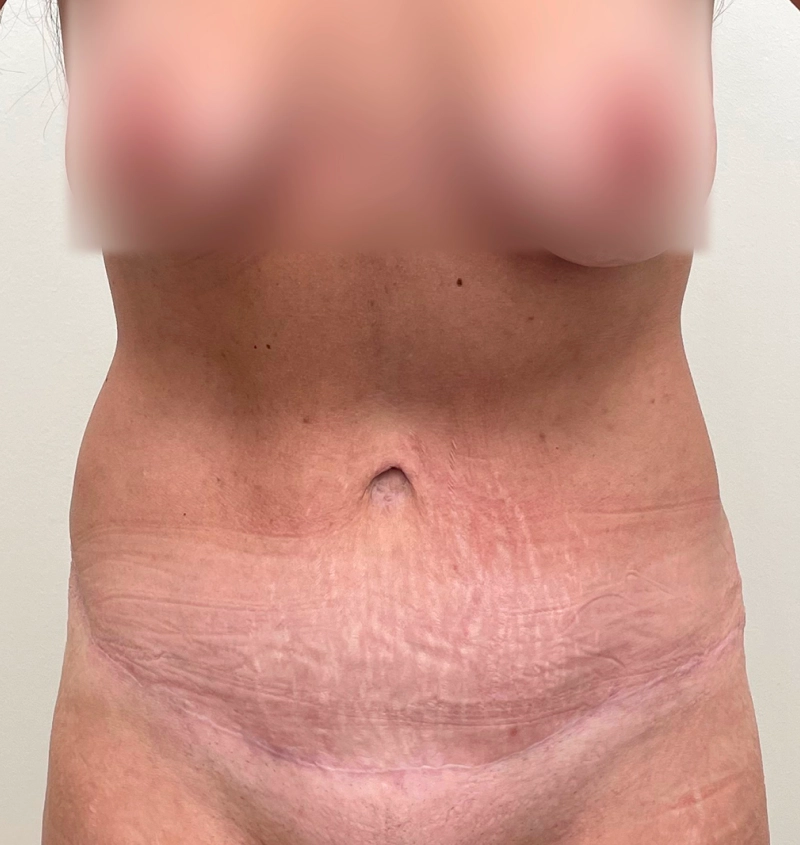 Tummy tuck liposuction results front view