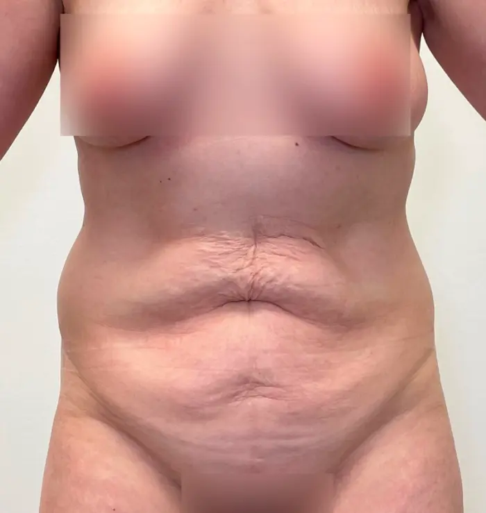 Tummy tuck liposuction results front view