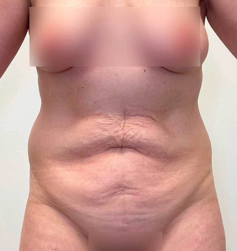 Tummy tuck liposuction results front view