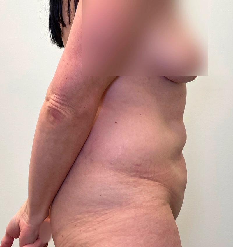 Tummy tuck liposuction results side view