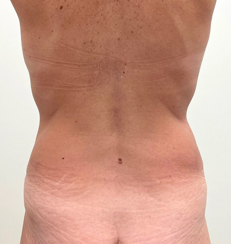 Tummy tuck liposuction results back view