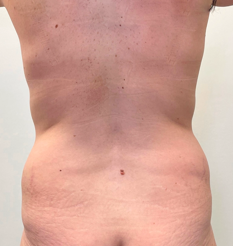 Tummy tuck liposuction results back view