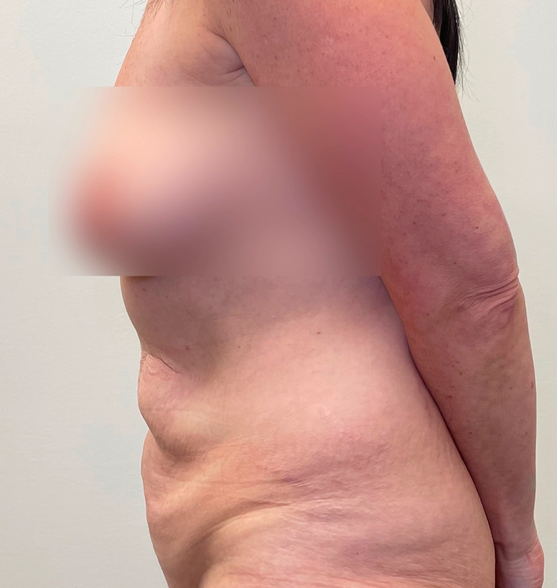 Tummy tuck liposuction results side view
