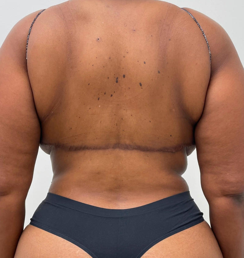 Bra-line back lift results back view