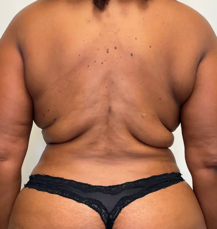 Bra-line back lift results back view