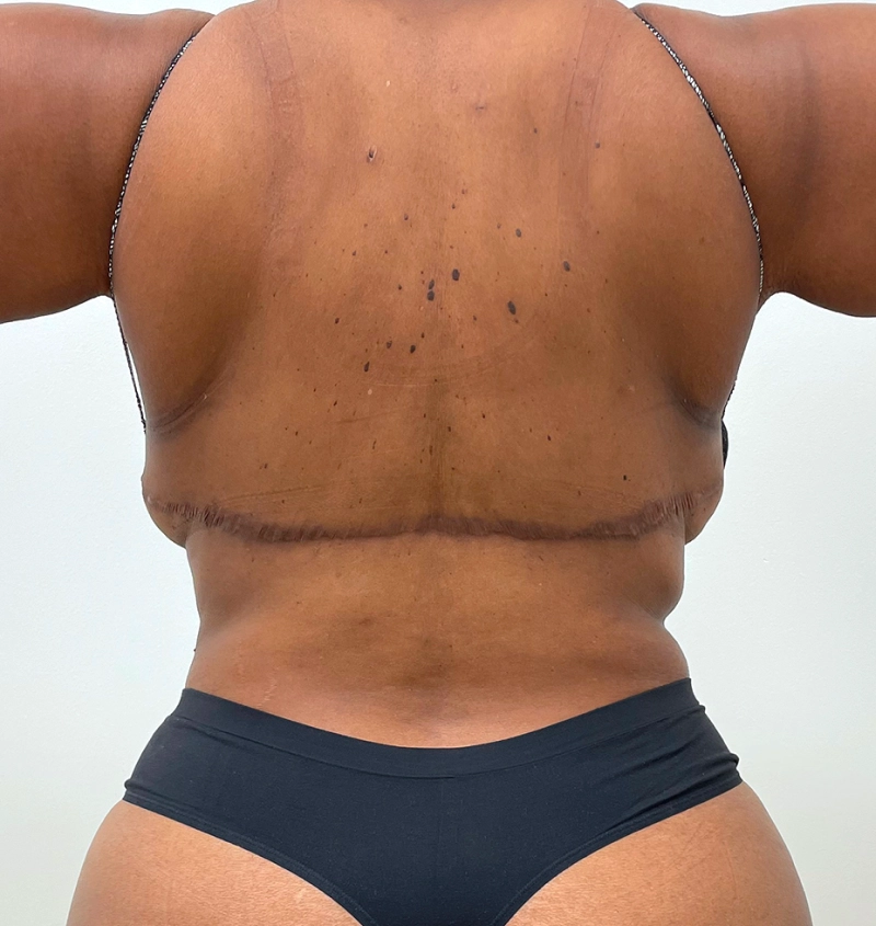 Bra-line back lift results back view