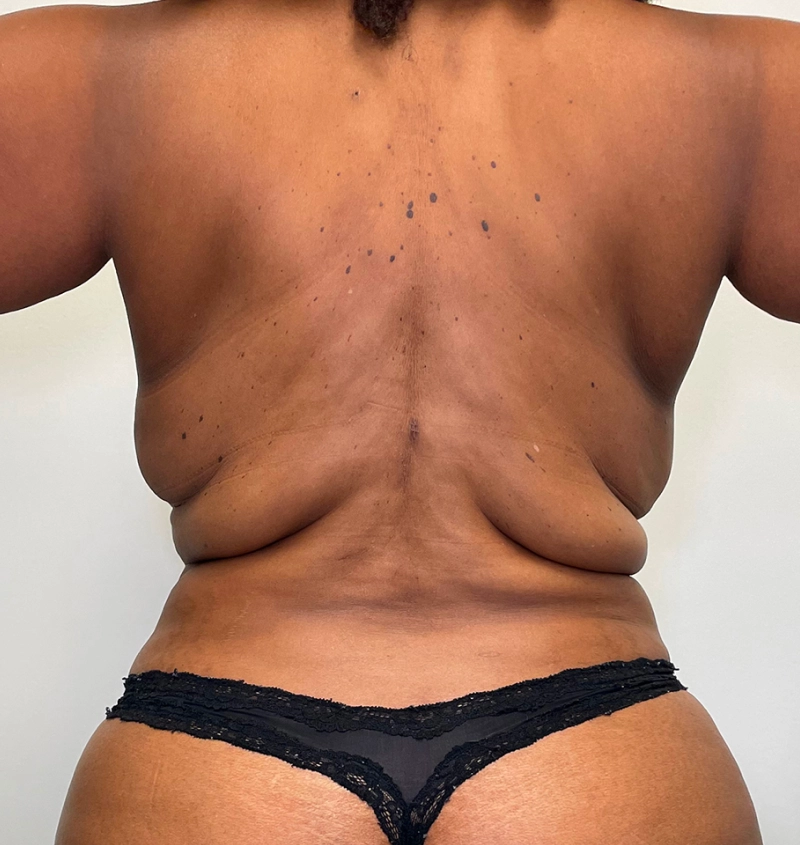 Bra-line back lift results back view