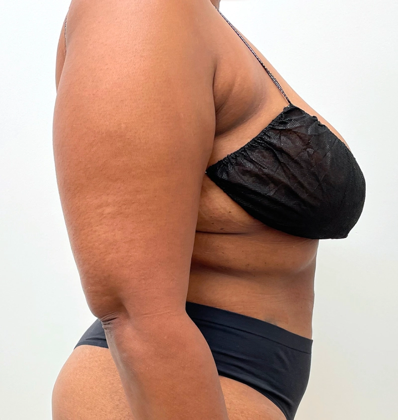 Bra-line back lift results side view