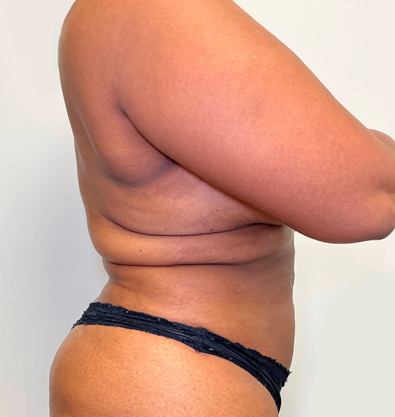 Bra-line back lift results side view