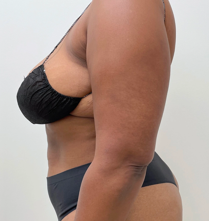 Bra-line back lift results side view