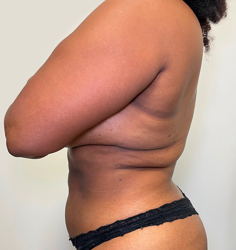 Bra-line back lift results side view
