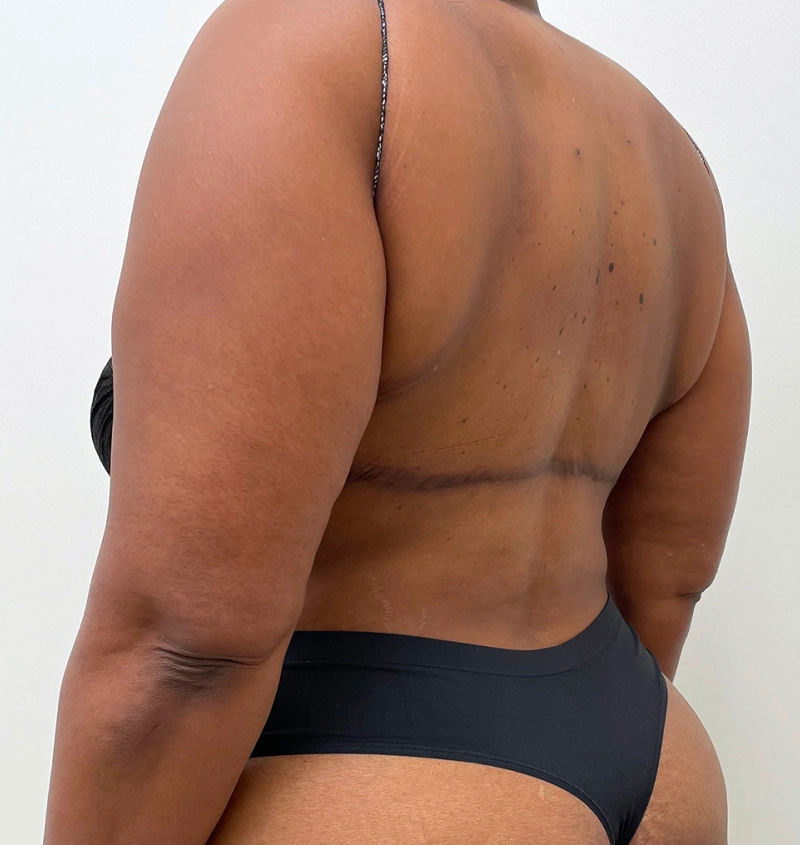 Bra-line back lift results side view