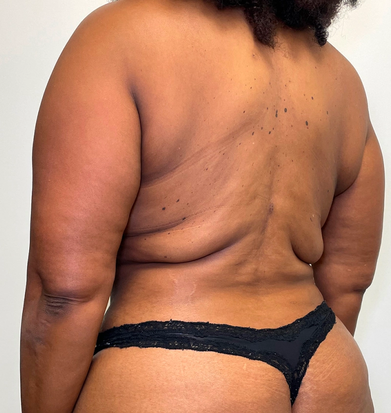 Bra-line back lift results side view