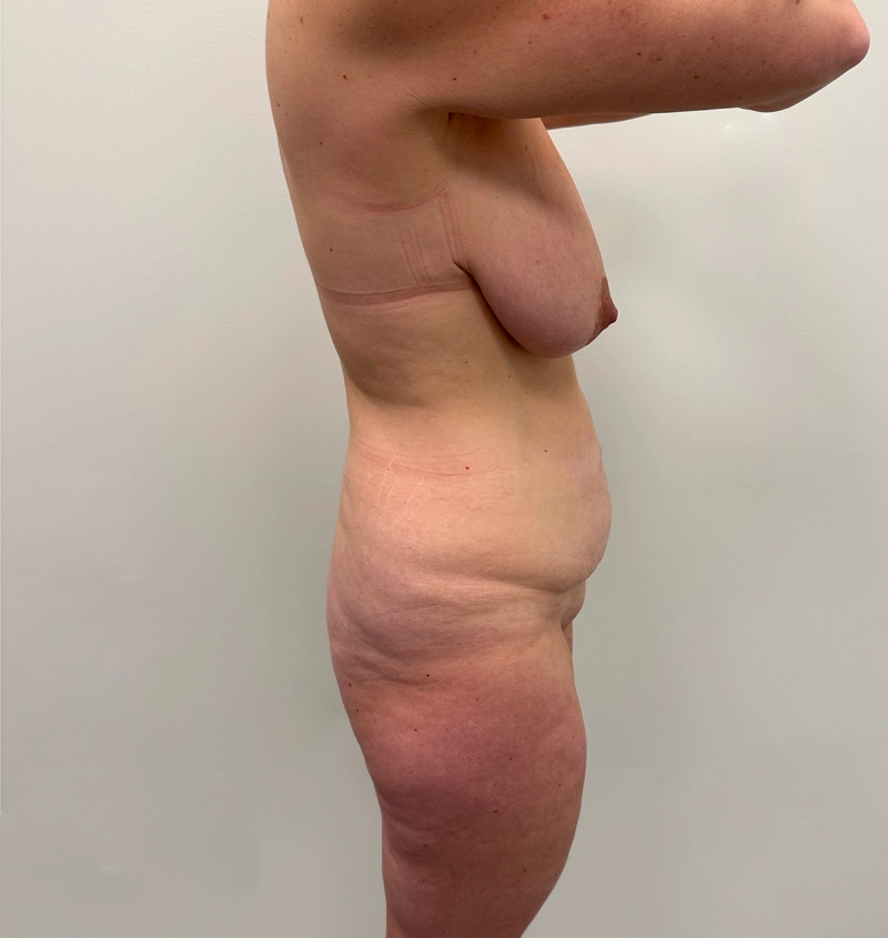 Post-weight loss results side view