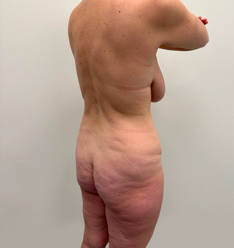 Post-weight loss results side view