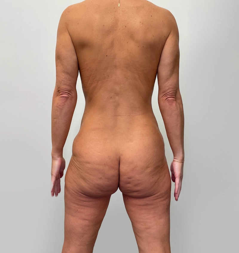 Post-weight loss results back view