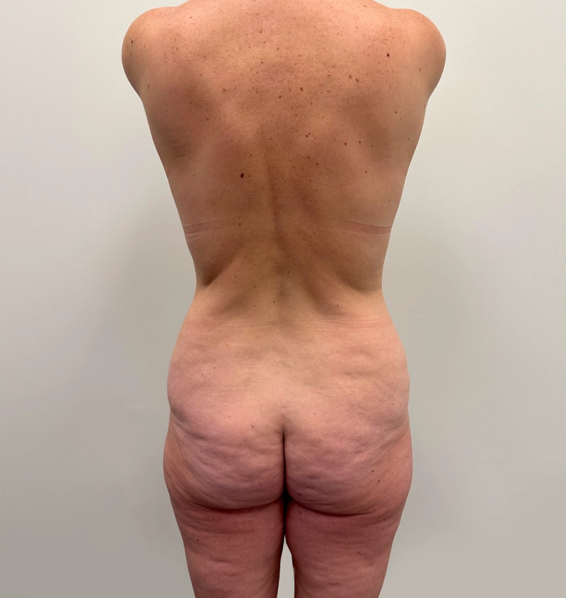 Post-weight loss results back view