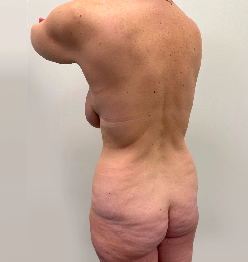 Post-weight loss results side view