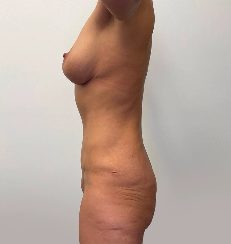 Post-weight loss results side view