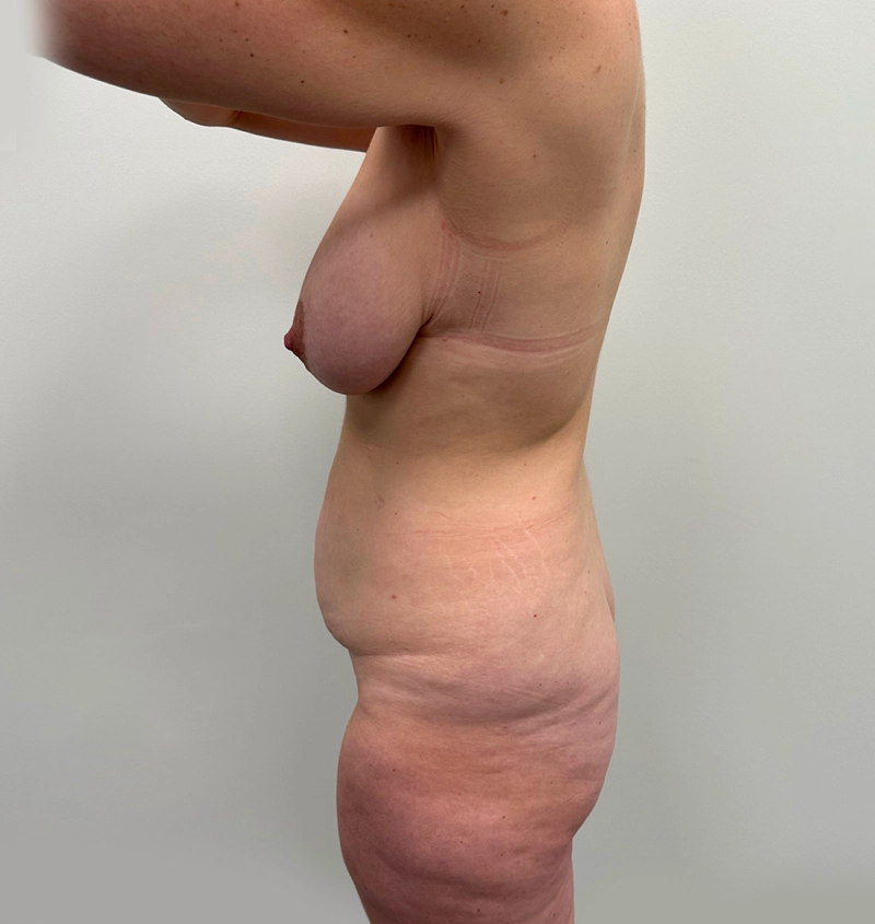 Post-weight loss results side view