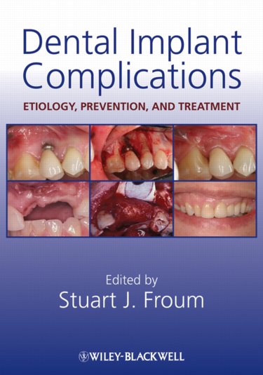 Dental Implant Complications: Etiology, Prevention, and Treatment Cover Image