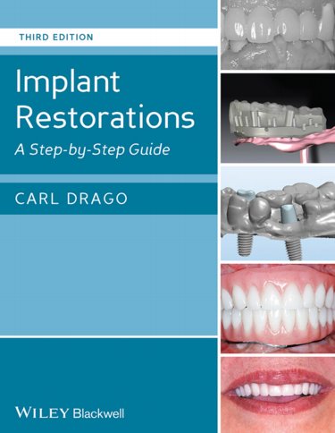 Implant Restorations: A Step-By-Step Guide Cover Image