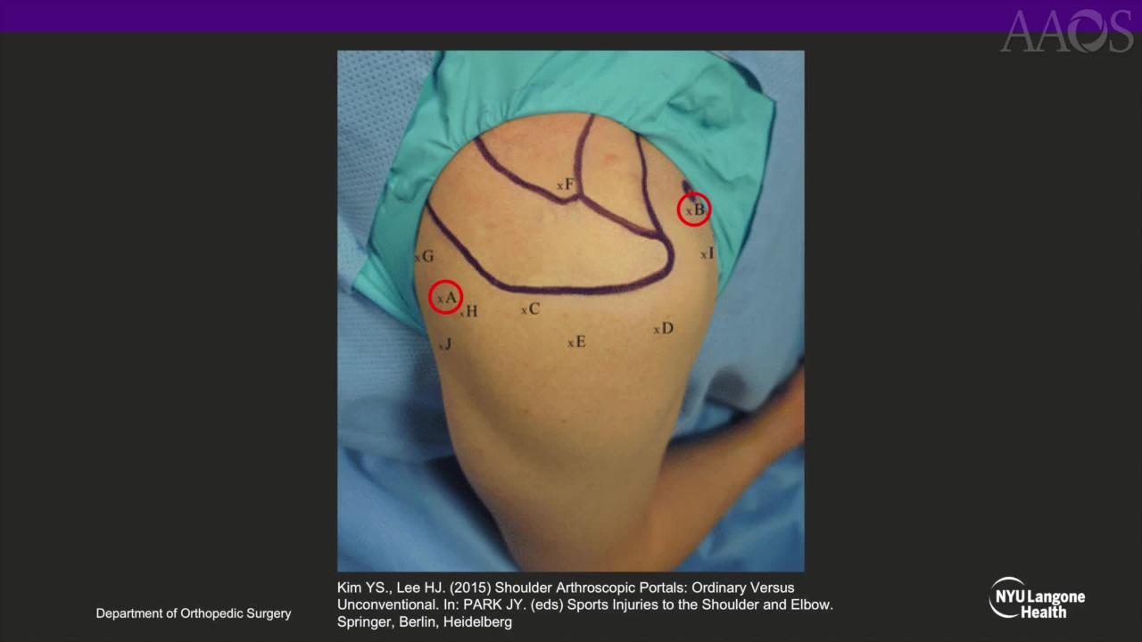 AAOS OVT Arthroscopic Removal of Rice Bodies From the Shoulder
