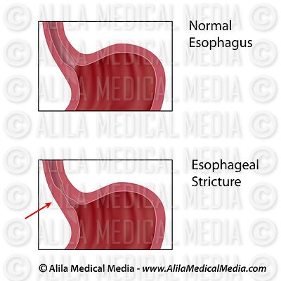 Alila Medical Media | Digestive System Images diagram of the esoph 