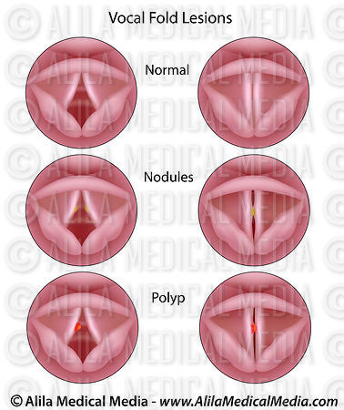 alila-medical-media-vocal-cord-lesions-medical-illustration