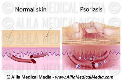 Alila Medical Media | Immune System Images oral thrush diagram 