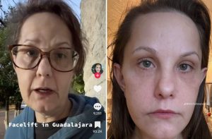 Before and after facelift photos of Michelle Wood.