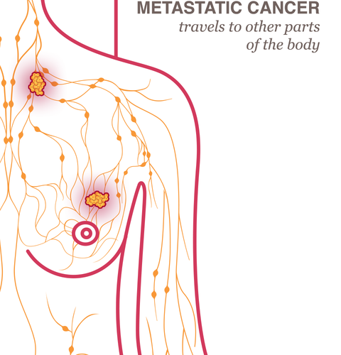 Non cancerous tumor in breast