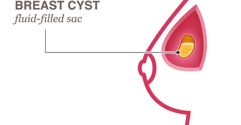 cyst breast lump cysts fluid cancer small feel tumor filled know disorders benign cancerous sac would cause