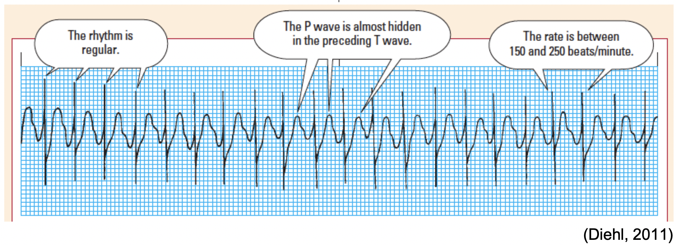 Introduction To Telemetry Monitoring For Arrhythmias Nursing Ce Course Nursingce