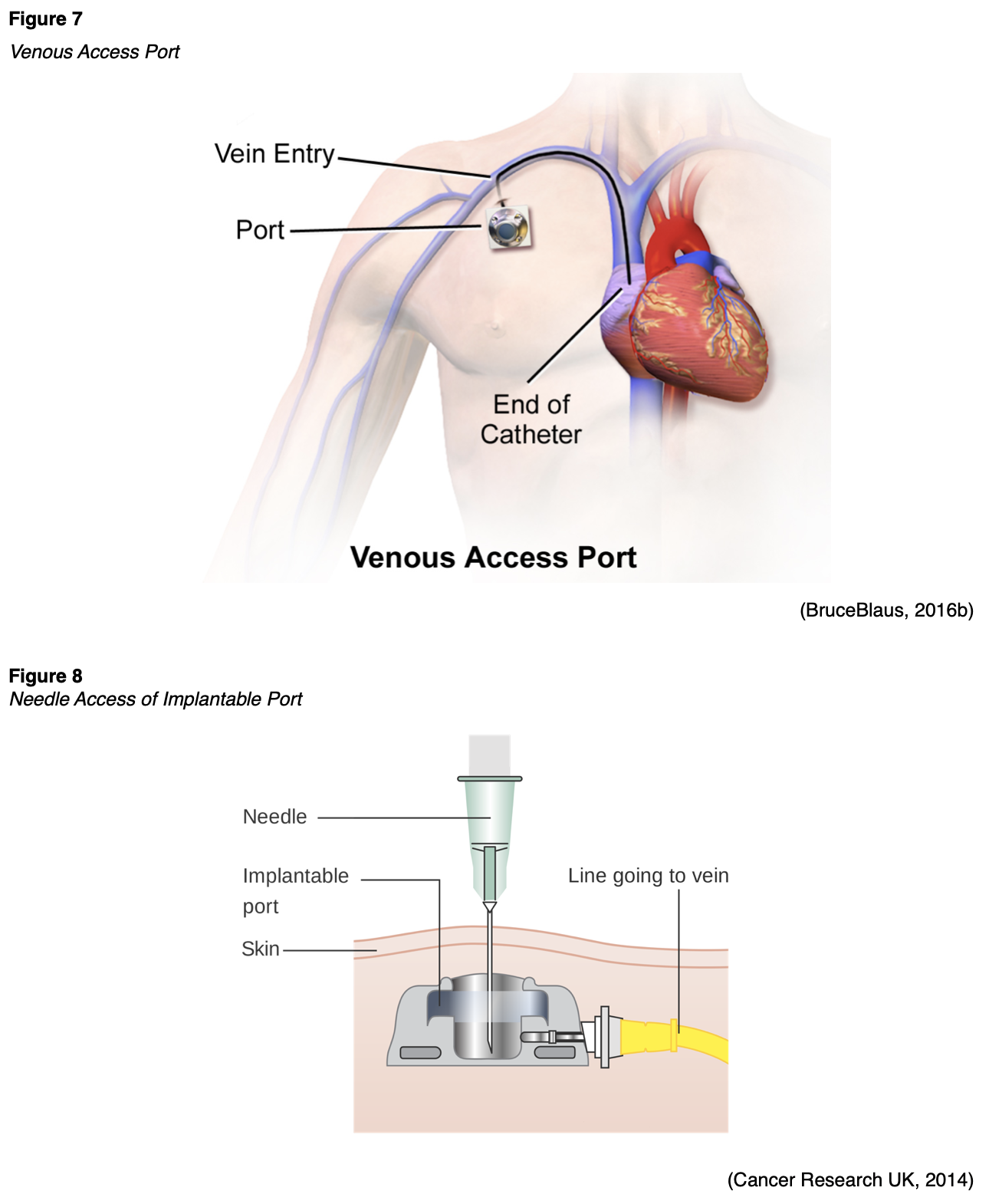 Porta Catheter Placement Porta Catheter Placement