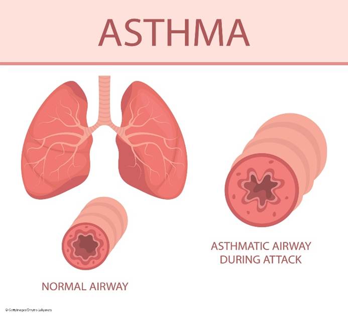 normal airway; blocked airway