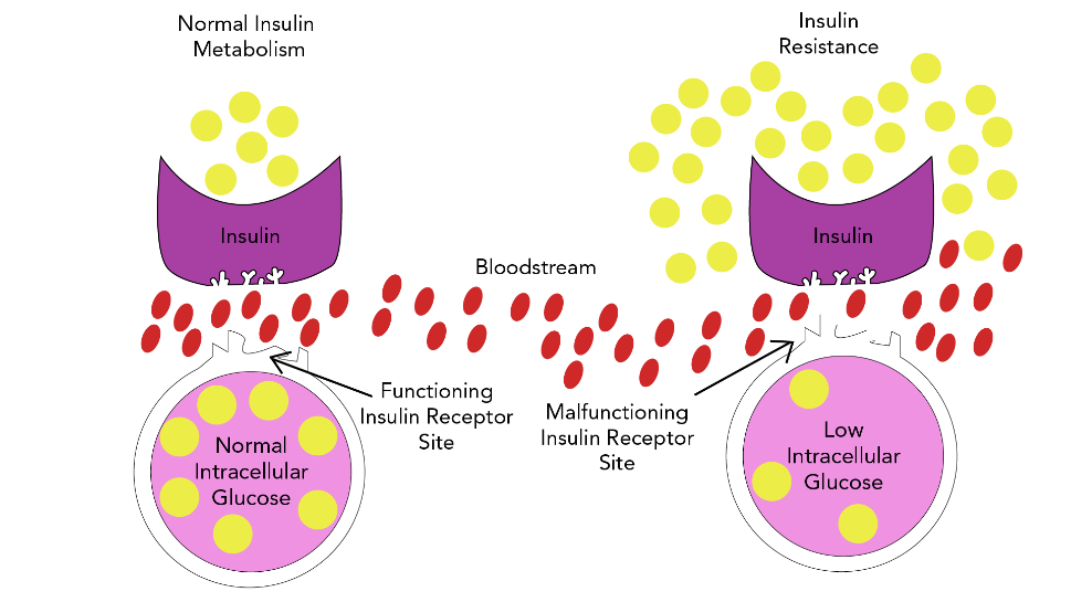 example of insulin resistance model