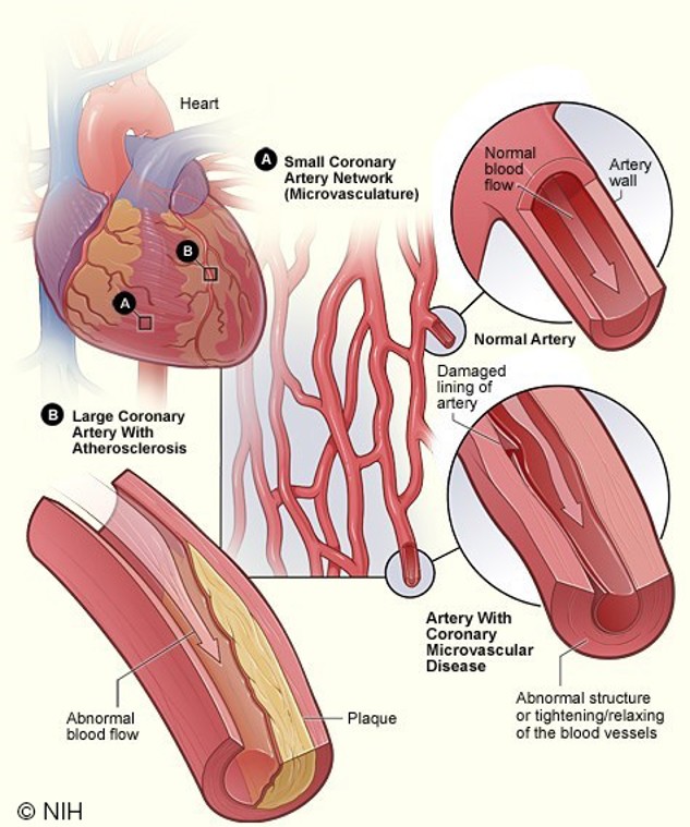 Plaque build up in coronary artery disease