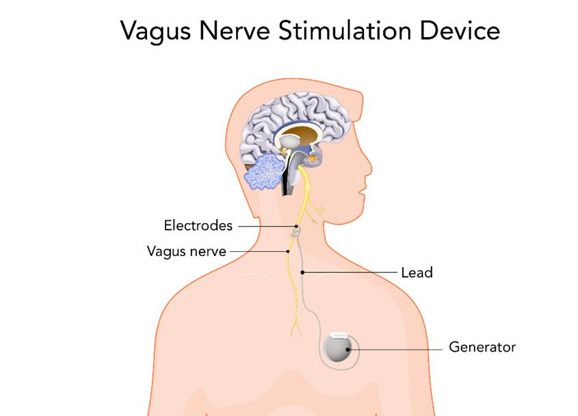 device for vagus nerve stimulation